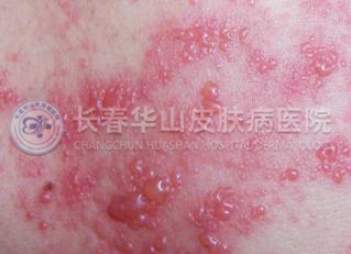 带状疱疹怎样治疗最好