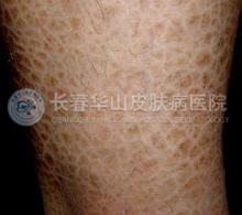 杭州鱼鳞病的治疗医院哪家好