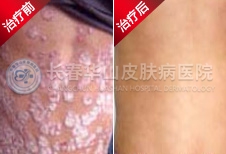 ���ƺ�Ƥ��������ԭ��������Ƥ������