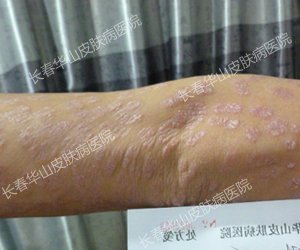 告别银屑病,事业爱情双丰收