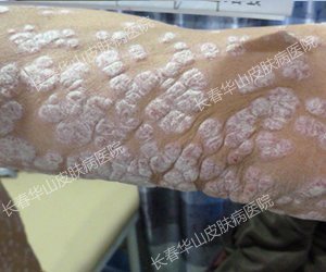 告别银屑病,事业爱情双丰收