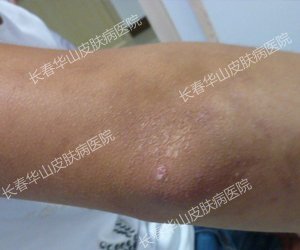 告别银屑病,事业爱情双丰收