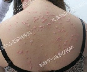 用心守护,女孩战胜银屑病