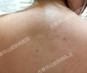 用心守护,女孩战胜银屑病