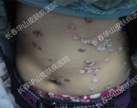 没有银屑病,童年乐无边