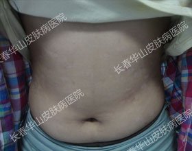 没有银屑病,童年乐无边