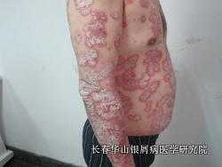 银屑病症状