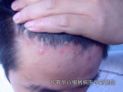 银屑病症状