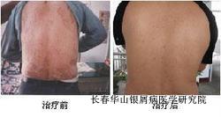 银屑病治疗