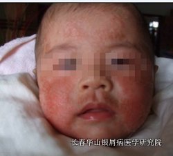 ÒøÐ¼²¡Ö¢×´