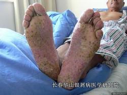银屑病症状