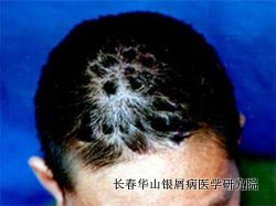 头部银屑病症状