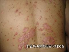 ÒøÐ¼²¡Ö¢×´