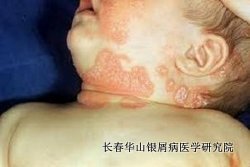 银屑病症状治疗