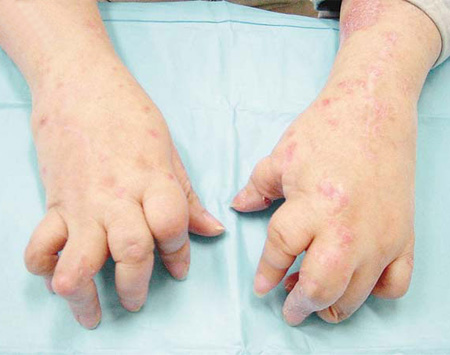 手部牛皮癣是什么症状