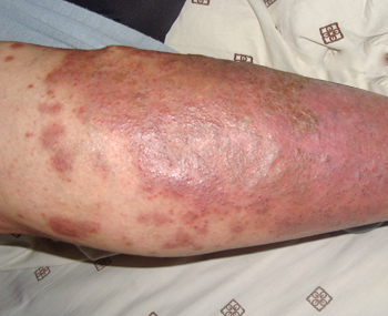 银屑病怎么护理