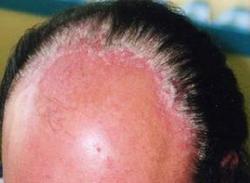 头部牛皮癣症状是什么