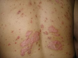 ҩ������ţƤѢ��Ҫע��ʲô