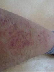 牛皮癣怎么治疗呢