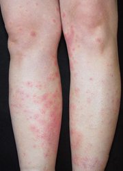 女性得牛皮癣的病因是什么