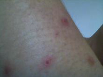 牛皮癣进行期有哪些注意事项