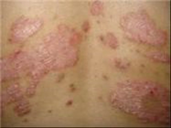 秋冬季节如何护理牛皮癣