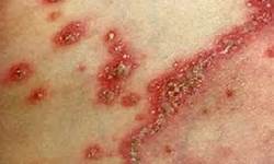 诱使牛皮癣病发的原因是什么