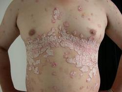 胸部牛皮癣护理方式有哪些