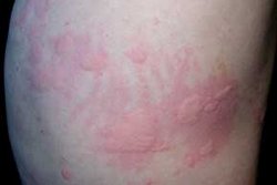 长春牛皮癣研究院怎样