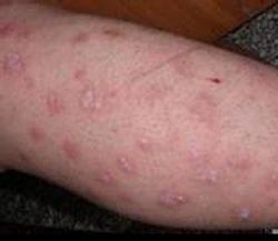 吉林市有治牛皮癣的吗