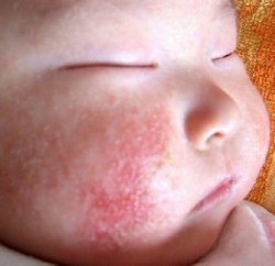 儿童牛皮癣的发病原因