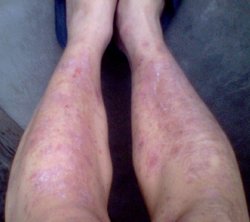 治疗牛皮癣选择什么方法好