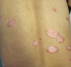 牛皮癣在中医上有哪些分型