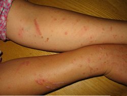 牛皮癣最基本的症状都有何表现