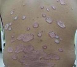 牛皮癣疾病,牛皮癣病因