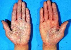 关节型牛皮癣,牛皮癣常识