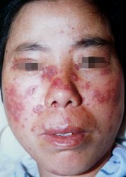 ����ţƤѢ,ͷ��ţƤѢ