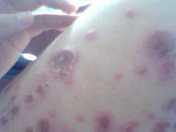 牛皮癣疾病,牛皮癣病因