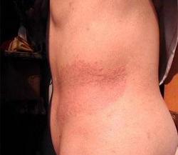 牛皮癣疾病,牛皮癣部位