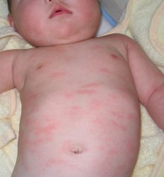 牛皮癣疾病,特效药