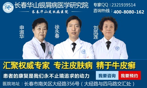 头部牛皮癣患者可以怎样去屑