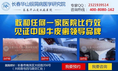 牛皮癣患者养宠物要注意哪些方面