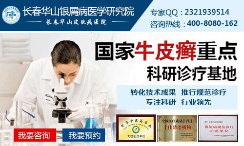 牛皮癣治疗时要注意哪些误区