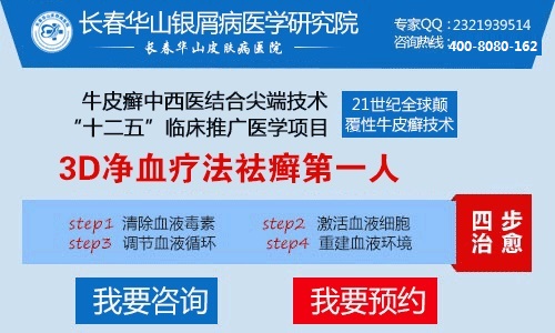 患上了寻常型牛皮癣该怎样治疗