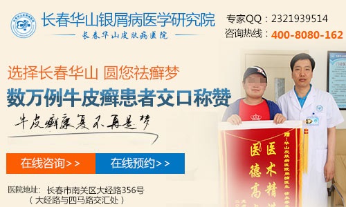 得了牛皮癣要怎样治疗会比较好