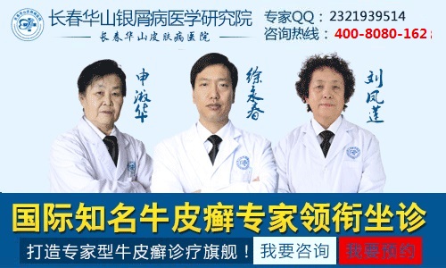 怎样预防牛皮癣的病情加重会比较好