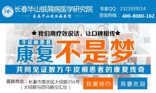 女性牛皮癣患者该怎样预防病情加重