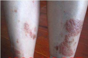 长春博润银屑病医院 长春博润银屑病医院