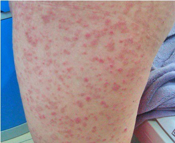 长春博润银屑病医院 长春博润银屑病医院