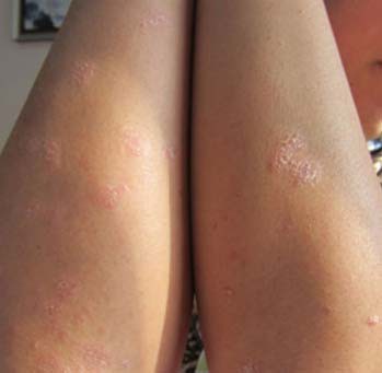 长春博润银屑病医院 长春博润银屑病医院